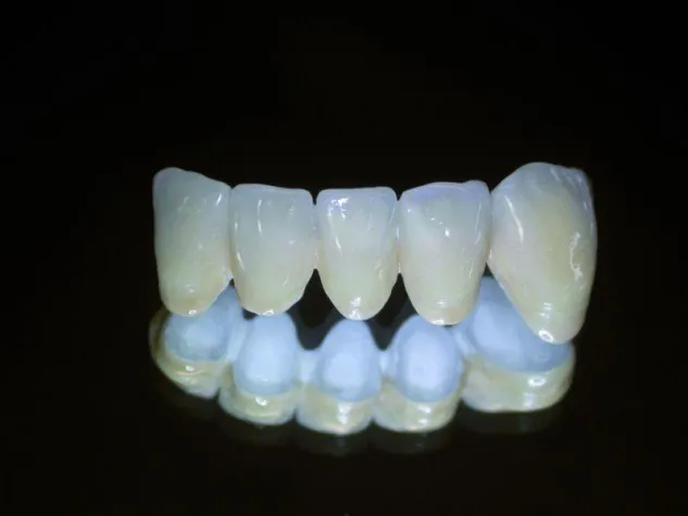 Bild: Die neue Werkstoffklasse in der Prothetik: Bio HPP (High Performance Polymer)