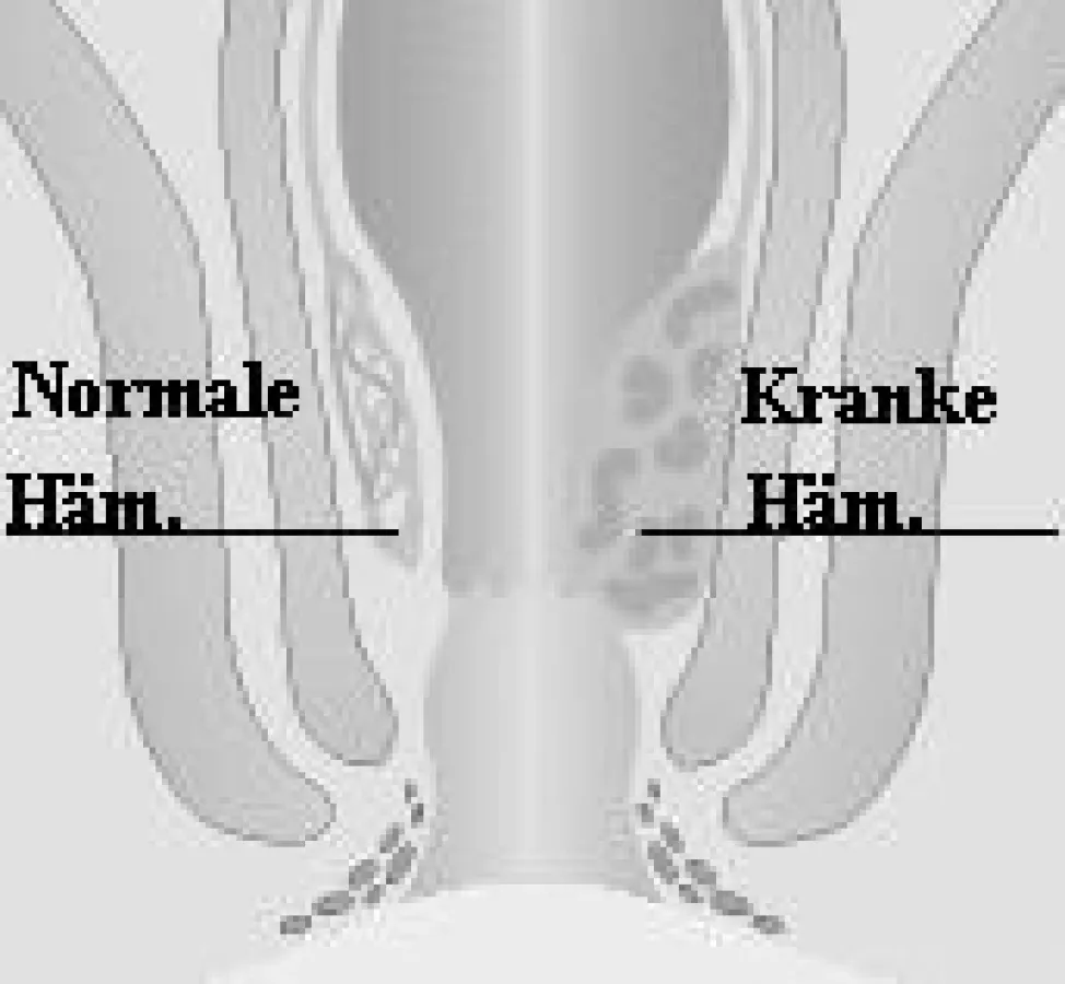Hämorrhoiden