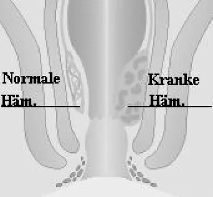 Bild: Peinliche Hämorrhoiden?