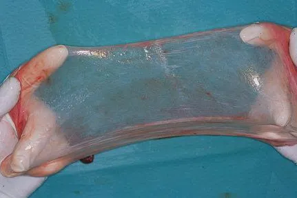 Bild: Mehr Amnion-Transplantate für die operative Augenheilkunde