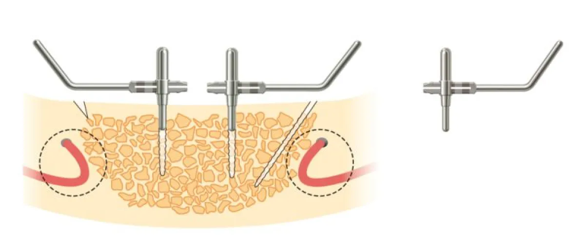 SKY Locator® anguliert von bredent