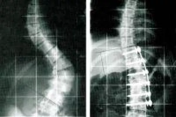 Bild: Mit einer Wirbelsäulenversteifung Beweglichkeit zurück gewinnen.