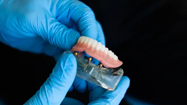 Bild: Gibt es Alternativen zu Implantaten mit denen sich ein Zahnimplantat vermeiden lässt?