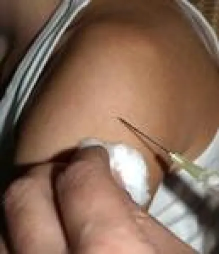 Bild: Impf-Diskussionen: Deutsche Chirurgen rufen dringend zu regelmäßigen Tetanus-Impfungen auf