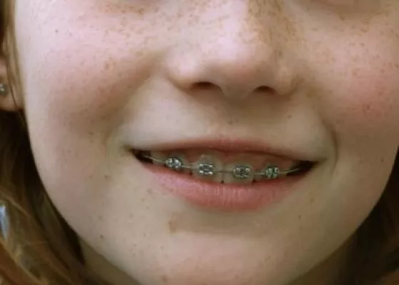 Bild: Ab welchem Alter ist eine Zahnzusatzversicherung sinnvoll?