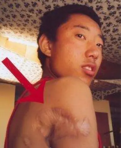 Überlebender des Massakers von Tongkor in Osttibet erreicht das Exil Bild: Überlebender des Massakers von Tongkor in Osttibet erreicht das Exil
