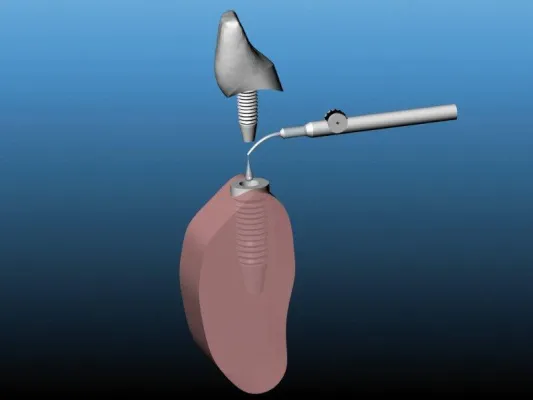 Bild: GapSeal® - Hohlraumversiegelung als Präventionsmaßnahme für Implantate