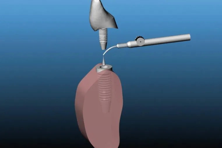 Bild: GapSeal® - Hohlraumversiegelung als Präventionsmaßnahme für Implantate
