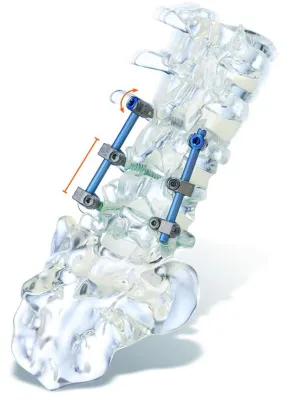 Bild: Fusion trifft auf Dynamik-ulrich medical ermöglicht dorsale Hybridinstrumentierung mit Stab-Schrauben-Systemen