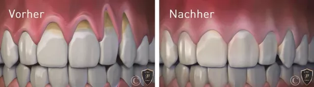 Bild: Zahnfleischrückgang: Neue innovative Behandlung durch sanftes Verschieben des Zahnfleischs