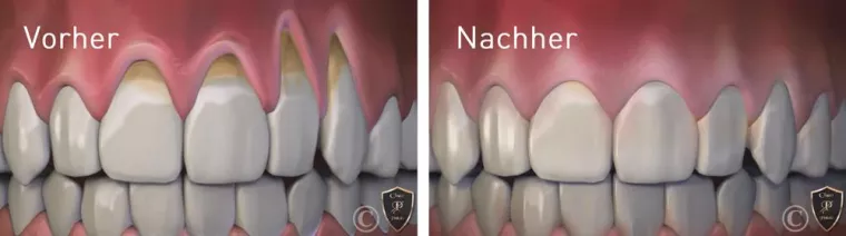 Bild: Zahnfleischrückgang: Neue innovative Behandlung durch sanftes Verschieben des Zahnfleischs