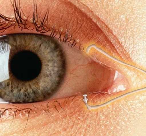 Bild: Post-LASIK-Komplikation Trockenes Auge