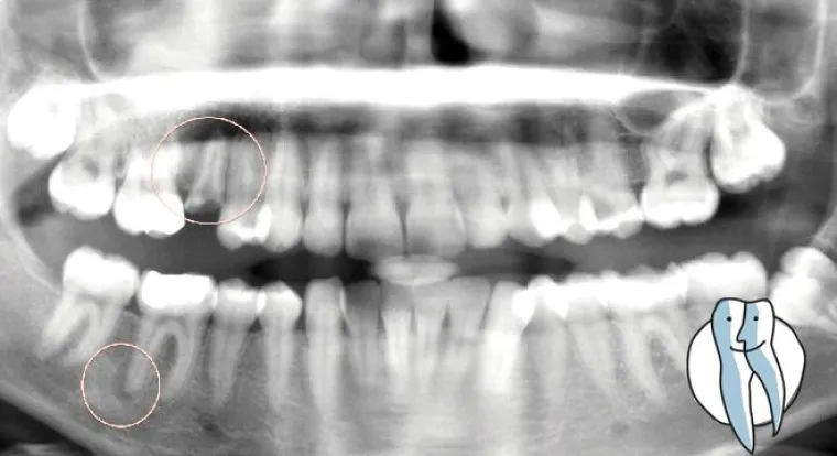 Bild: Der Nerv ist tot, was passiert mit dem Zahn?