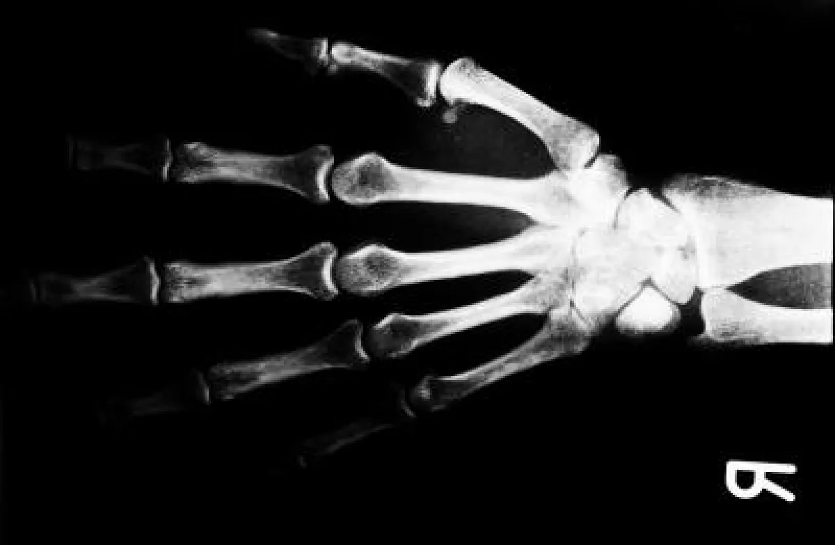 Biopolymere zur Behandlung von Knochenbrüchen. Bild: Sabine Koriath /pixelio.de