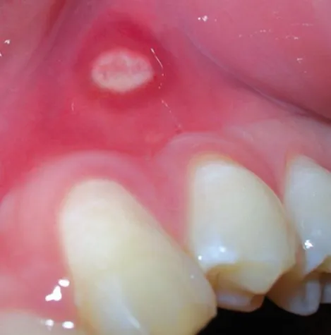 Bild: Aphthen - schmerzhafte Plagegeister im Mund