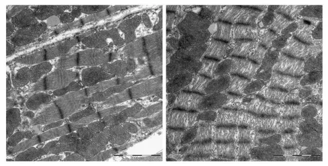 Bild: Hilfe bei Herzschwäche nach Chemotherapie