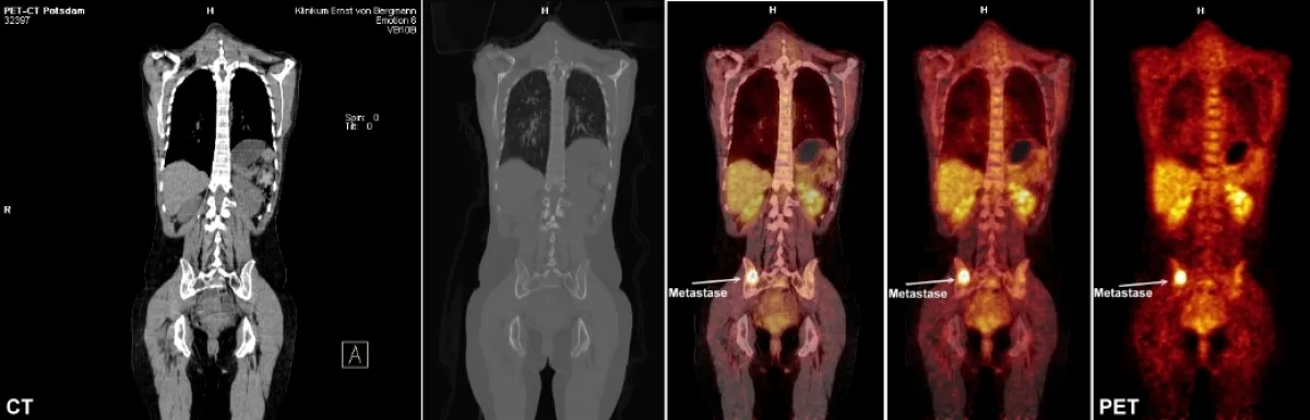 Untersuchungsaufnahmen einer Patientin, links CT, rechts PET, in der Mitte als Beispiel die Bildfusion