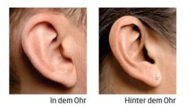 Bild: Ein oder zwei Hörgeräte? Hinter oder im Ohr?