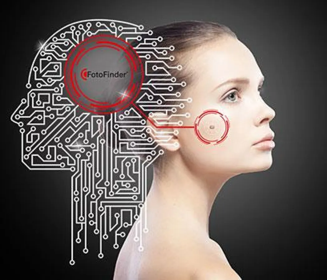 Künstliche Intelligenz in der Hautkrebserkennung