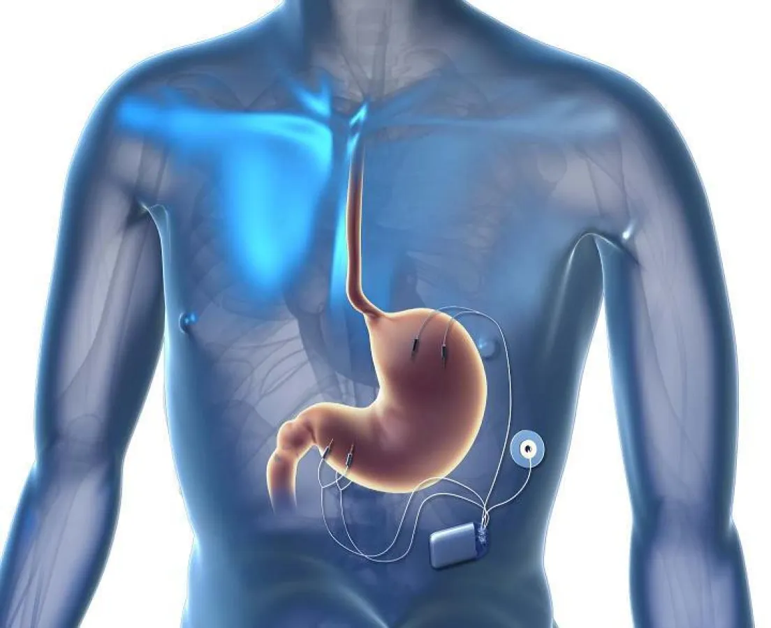Das neue Schrittmachersystem Tantalus wird speziell bei übergewichtigen Diabetikern angewendet