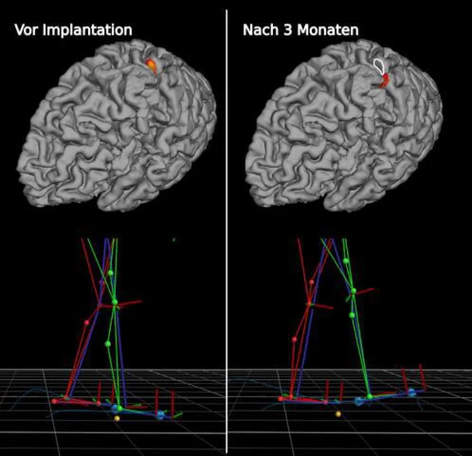 Die Fußheberschwäche der untersuchten Patienten (li. Bild) ist drei Monate nach der Implantation einer aktiven Prothese (re. Bild) zurückgegangen und das Gehirn der Betroffenen hat sich funktio ()