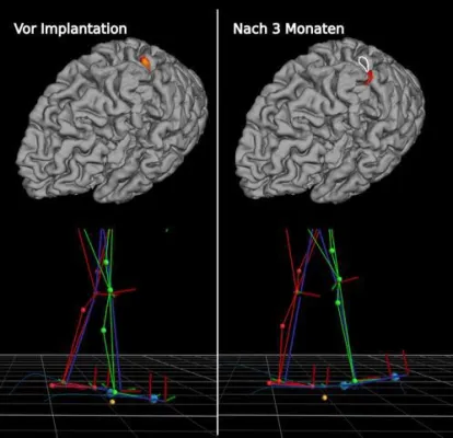Aktive Prothese verändert Hirnfunktionen von Schlaganfall-Patienten Bild: Aktive Prothese verändert Hirnfunktionen von Schlaganfall-Patienten