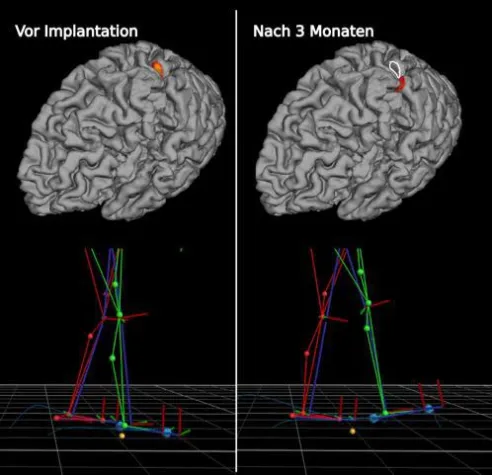 Aktive Prothese verändert Hirnfunktionen von Schlaganfall-Patienten Bild: Aktive Prothese verändert Hirnfunktionen von Schlaganfall-Patienten