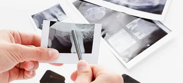 Bild: Wichtige Fakten über die professionelle Zahnreinigung