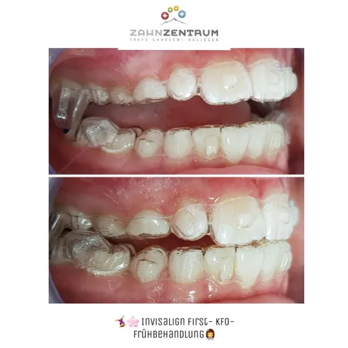Invisalign First: sanfte Kieferstellungskorrektur für Kinder Bild: Invisalign First: sanfte Kieferstellungskorrektur für Kinder