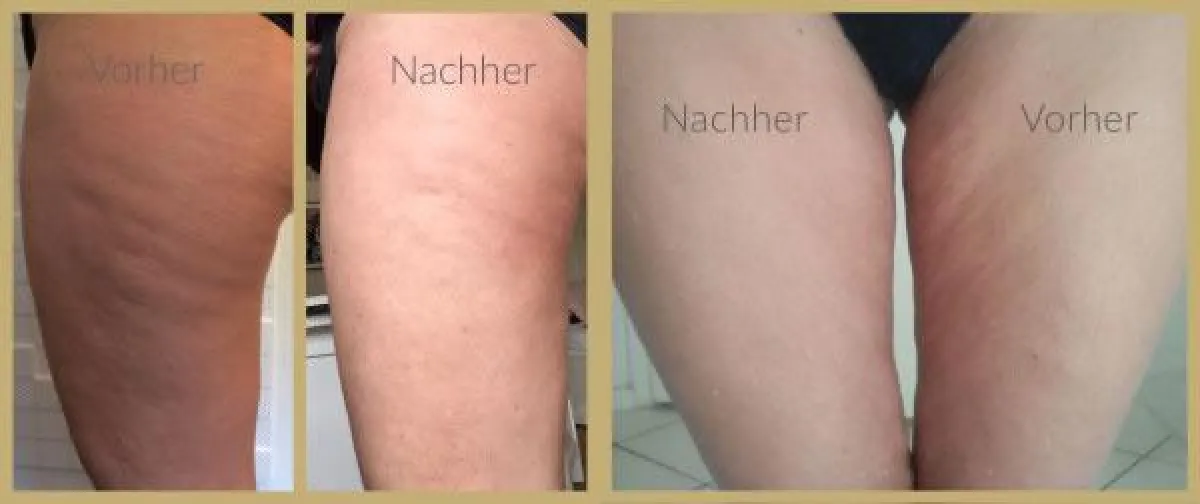 ByeByeCellulite - die revolutionare Creme von Dr. Juchheim Cosmetics