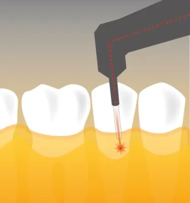 Bild: Zahnfleischkontrolle als Vorsatz für 2014