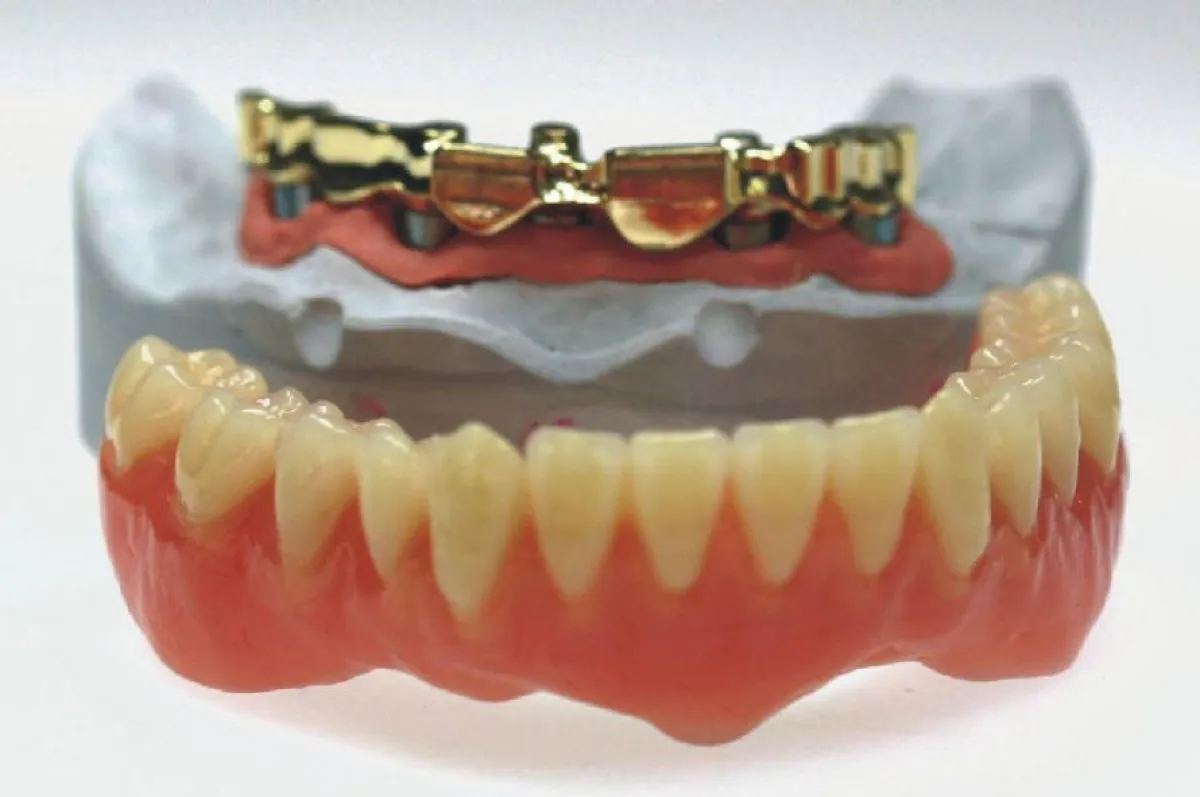 Ende des Gewackels: Nach der computergestützten Implantatplanung ist hier eine Prothese für den Unterkiefer eines 72Jährigen entstanden.