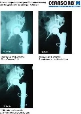 Bild: Cerasorb® M bei Hüftpfannenwechsel erfolgreich eingesetzt