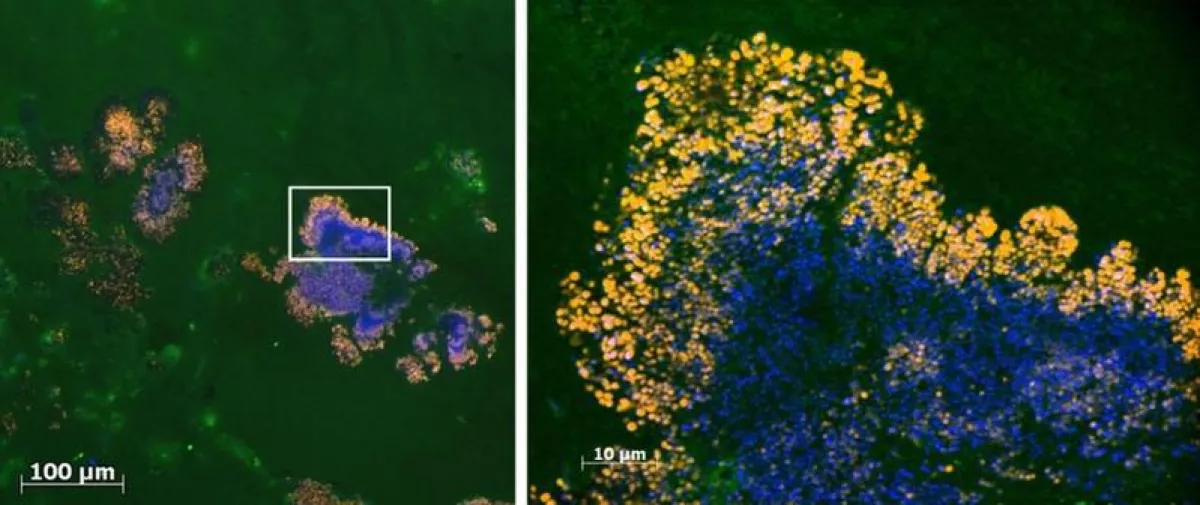 FISH Aufnahme eines Streptokokken-Biofilms auf einer menschlichen Herzklappe (Detaillierte Beschreibung in der PM)  (DHZB-Biofilmzentrum )