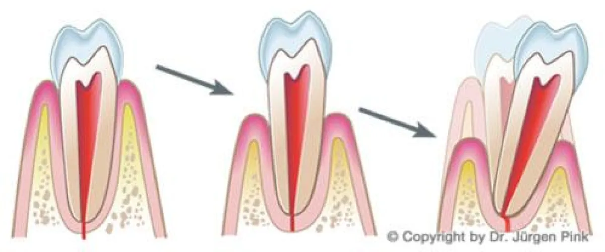 Stufen der Paradontitis