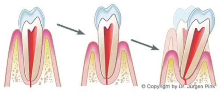 Parodontose: Eine tückische Bakterieninfektion des Zahnfleisches Bild: Parodontose: Eine tückische Bakterieninfektion des Zahnfleisches