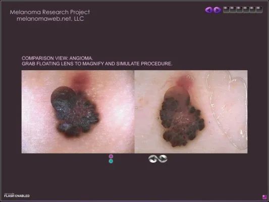 Bild: Melanom und Hautkrebs – Multimediale Familiensoftware optimiert Früherkennung