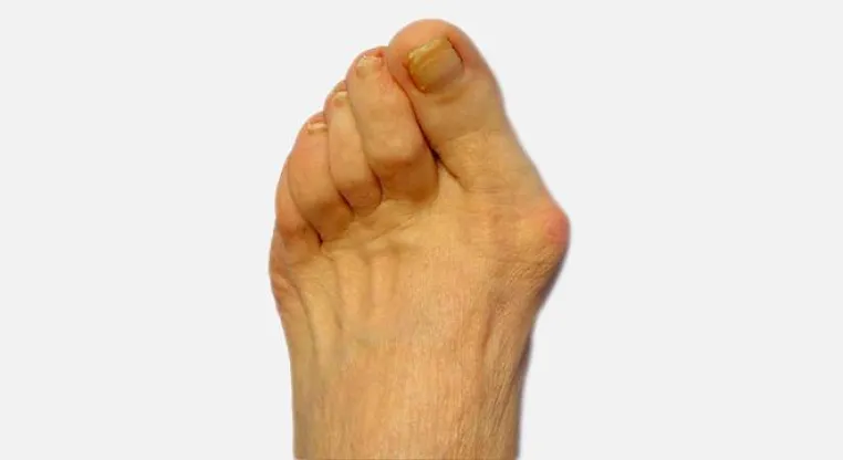 Bild: Computergesteuerte Ganganalyse in den CityPraxen Berlin: Hallux valgus bei Jugendlichen