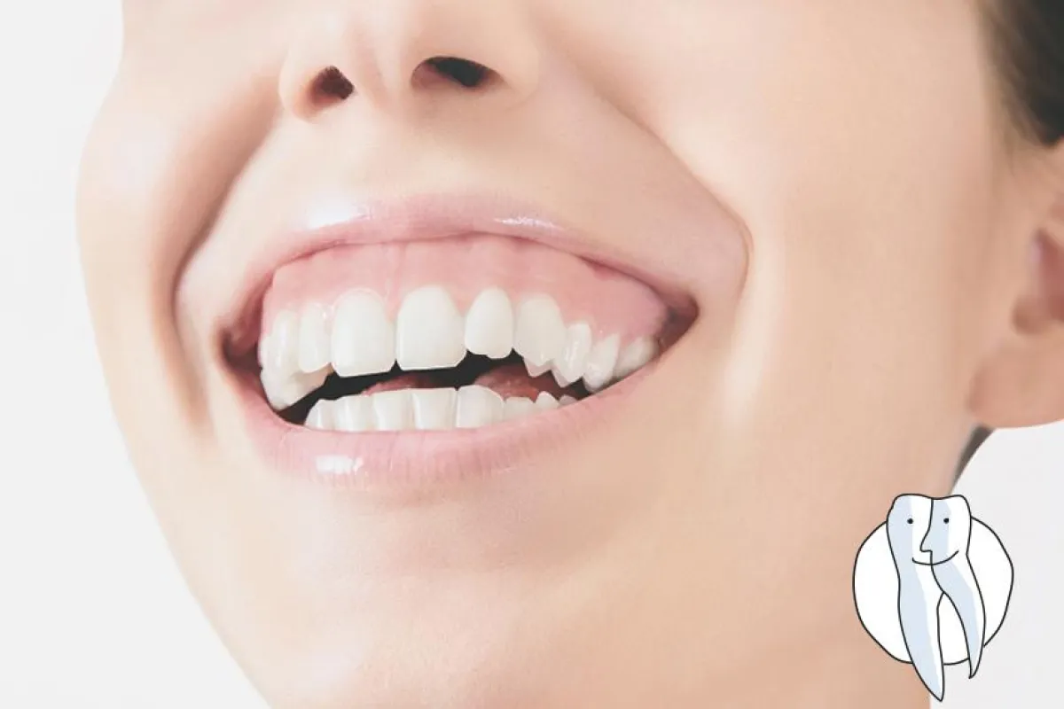 Gummy Smile  fotolia©ALDECAstudio