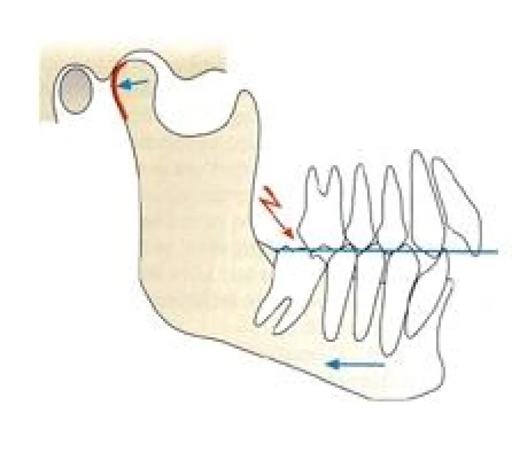 CMD kann bis in den Rücken wirken: Cranio Mandibuläre Dysfunktion durch Kippstand von Einzelzähnen