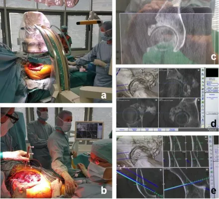 Bild: Optimierte Therapie für komplexe Knochentumoren des Beckens: GPS für Orthopäden und Pathologen
