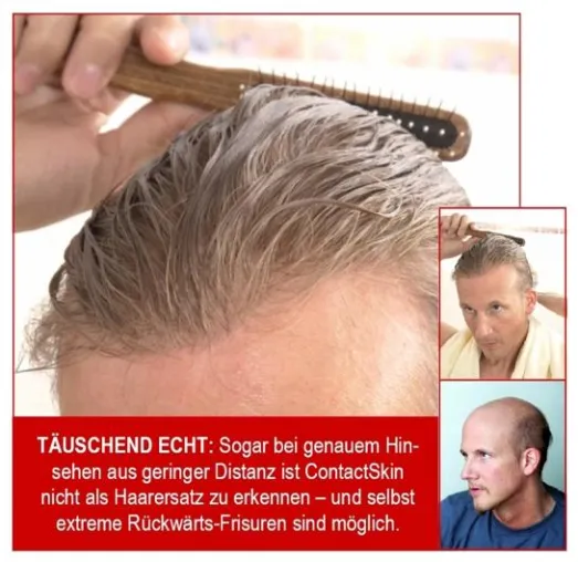 Bild: Erster Haarersatz, der völlig natürlich anmutet und sogar »mitwächst«
