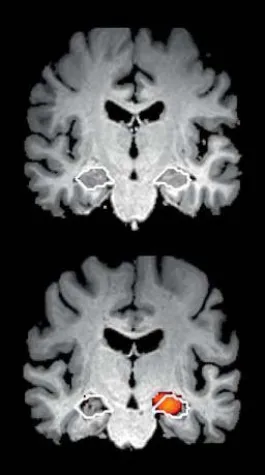 Neues Verfahren zur frühen Alzheimer-Diagnose Bild: Neues Verfahren zur frühen Alzheimer-Diagnose