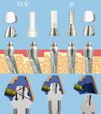 Bild: Die selbstzentrierende Transversalverschraubung – jetzt auch für das SKY fast & fixed Therapiekonzept