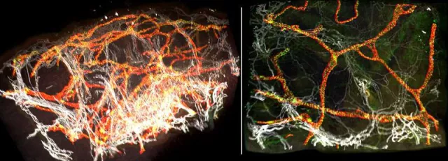 Bild: New method of analysing lymphoedema - Making digital 3D images of tissue