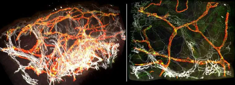 Bild: New method of analysing lymphoedema - Making digital 3D images of tissue