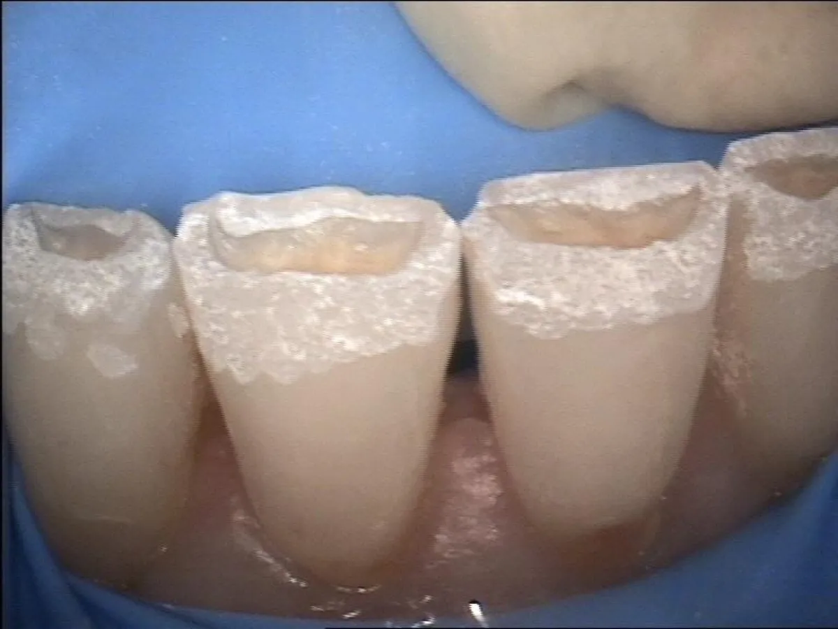 snfte Kariesentfernung mit dem Laser