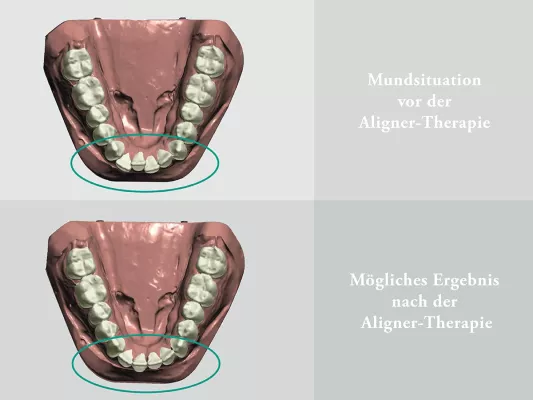 Bild: Aligner-Therapie: So einfach und komfortabel ist die Korrektur im Frontzahnbereich
