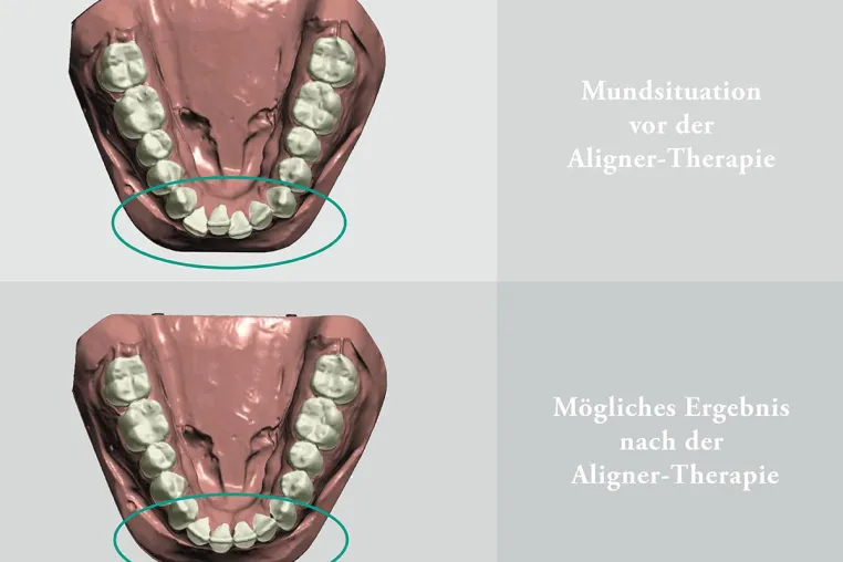 Aligner-Therapie: So einfach und komfortabel ist die Korrektur im Frontzahnbereich Bild: Aligner-Therapie: So einfach und komfortabel ist die Korrektur im Frontzahnbereich
