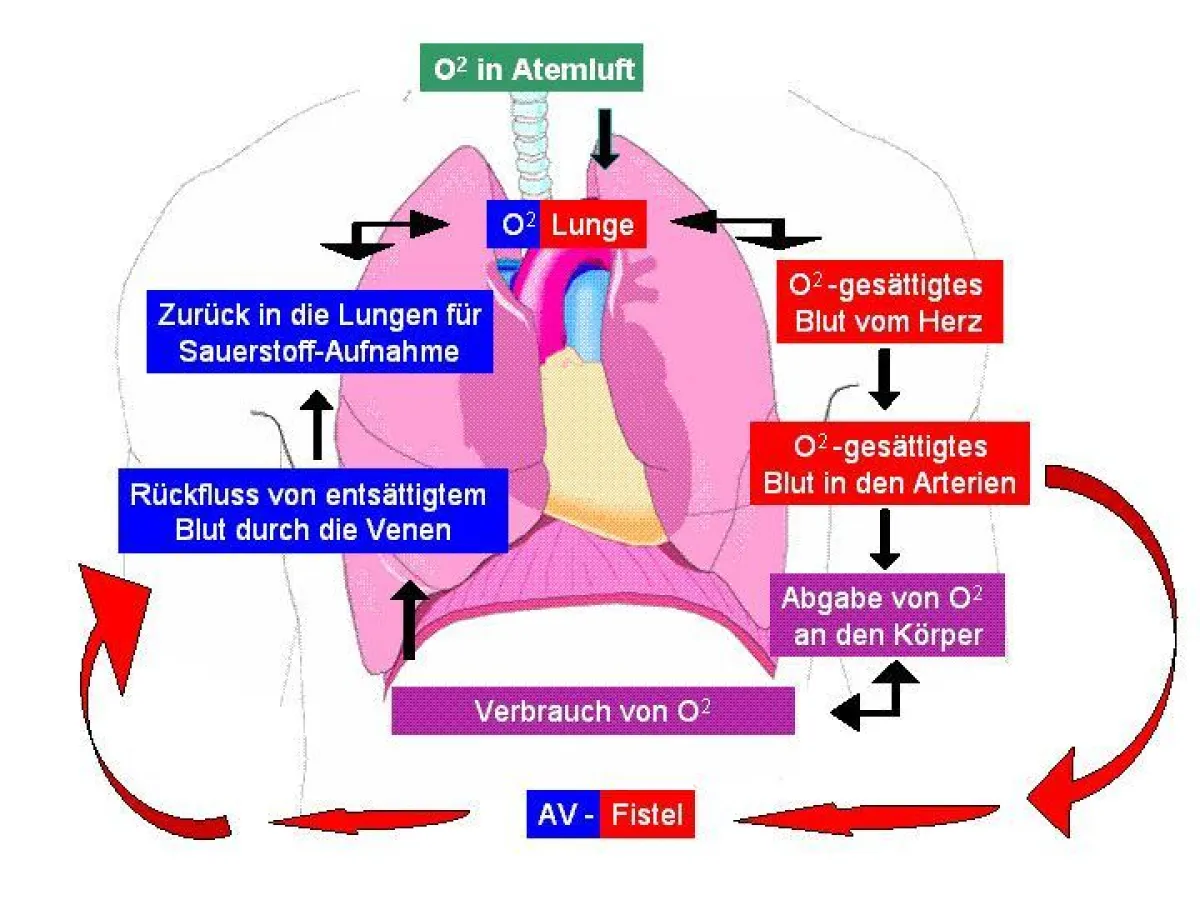 Die arteriovenöse Fistel im Unterleib wirkt wie